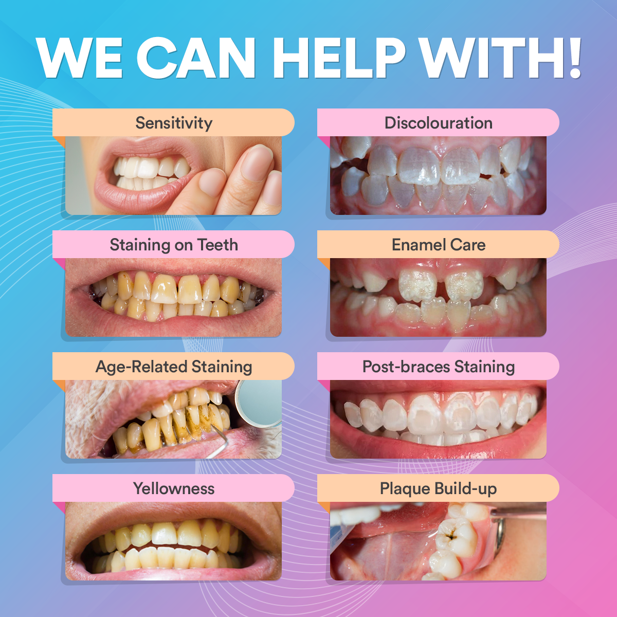 Advanced Teeth Whitening Kit PAP+ DP3