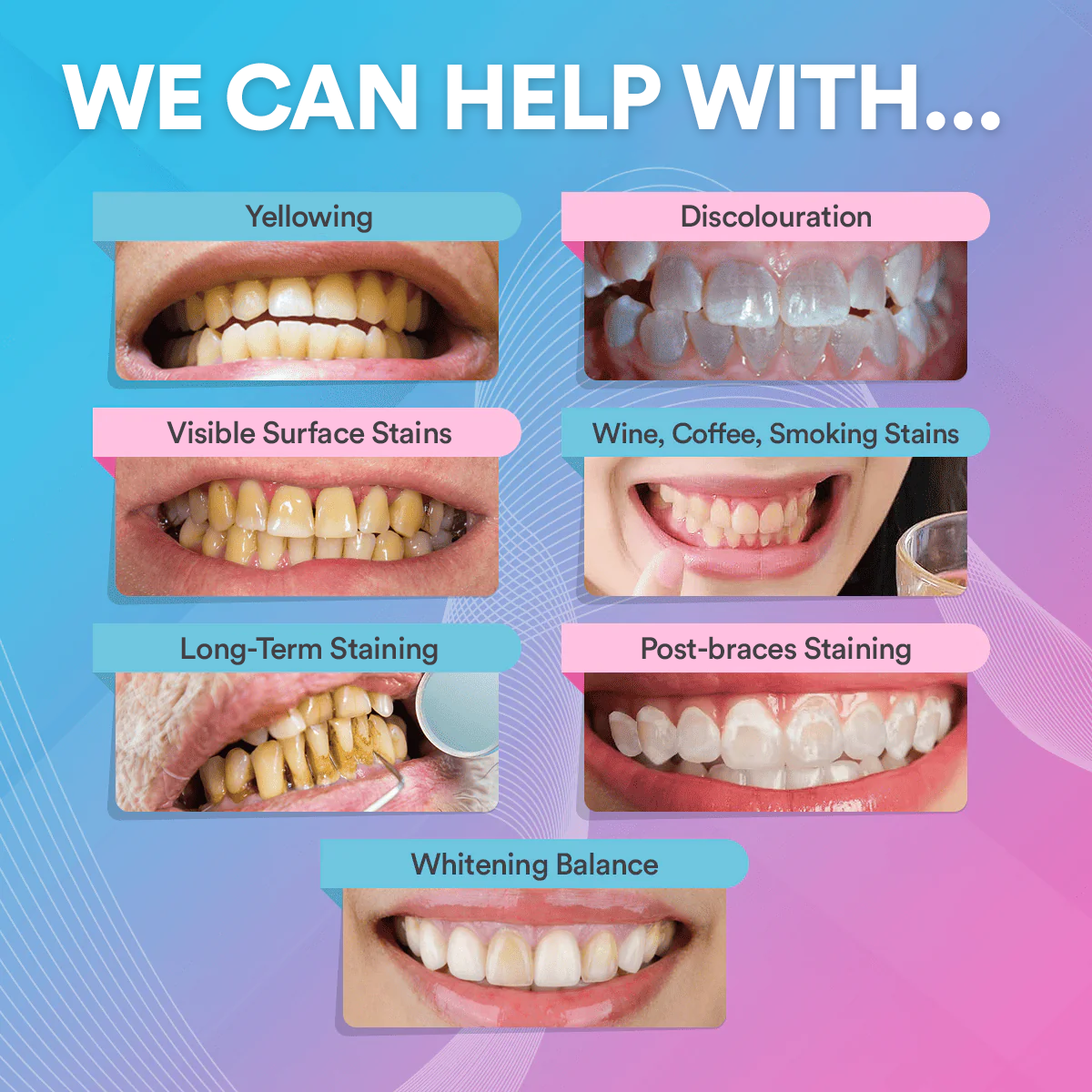 Teeth Whitening Strips (14 Treatments)